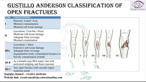 gusilo|Open Fractures (Gustilo